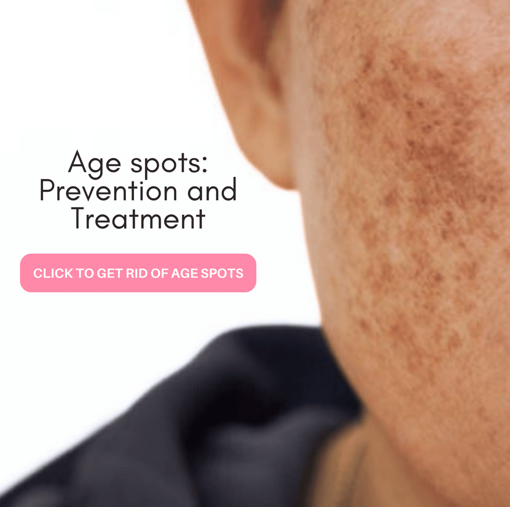Age spots: Treatment and Prevention