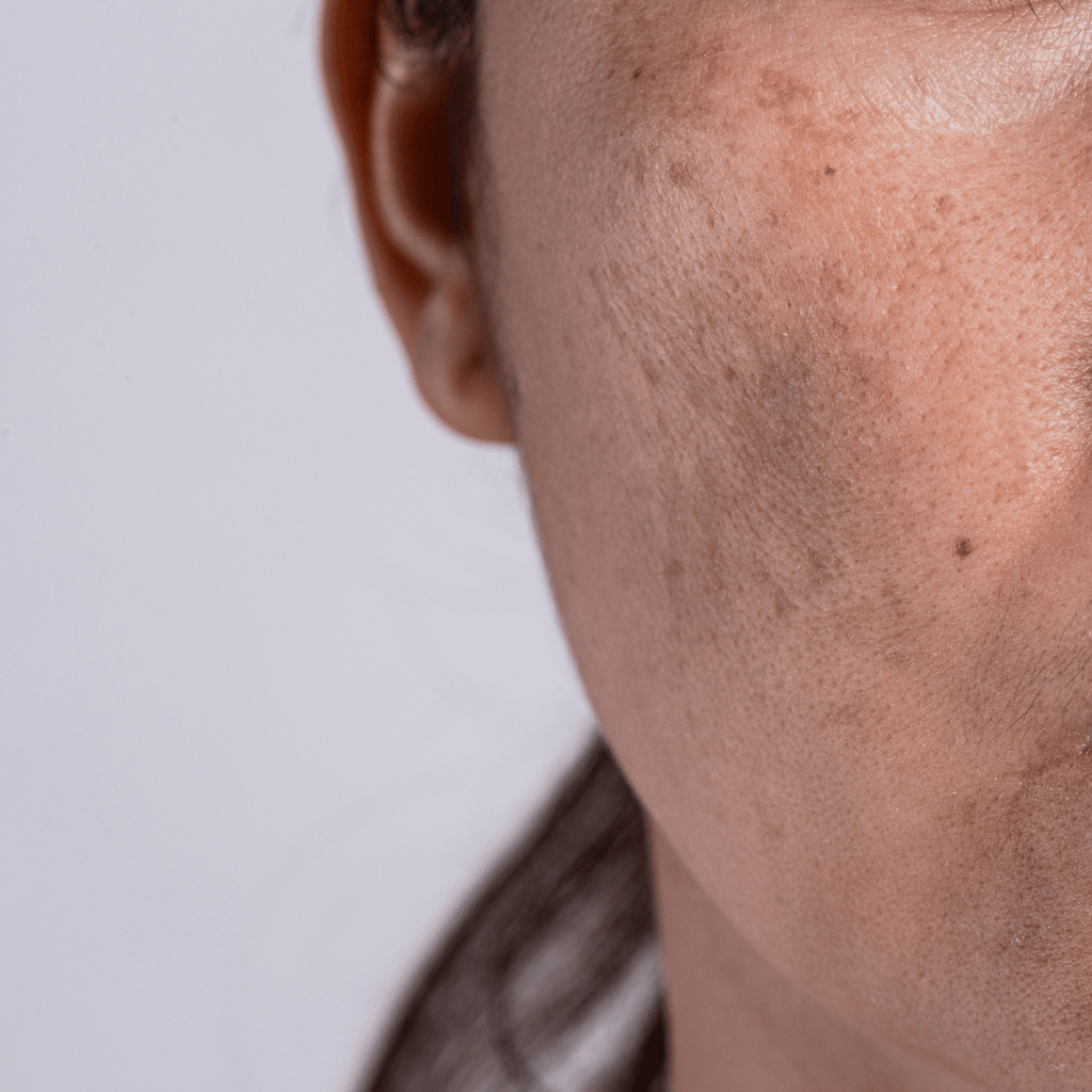 How to treat dark spots effectively?